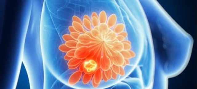 Sistemul de inteligență artificială B-RAD îmbunătățește detectarea cancerului mamar în studii internaționale